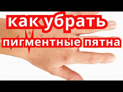 Яблочный уксус от пятен пигментных пятен на лице Веснушка как пишется