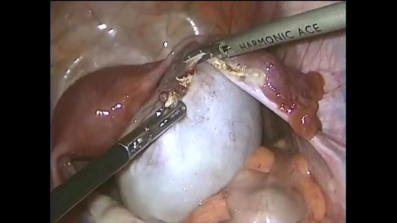Large Ovarian Cyst (10cm) - Laparoscopic Ovariotomy
