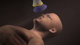 Product video: LifeVac Home Kit Anti-Choking Device - LVT1002