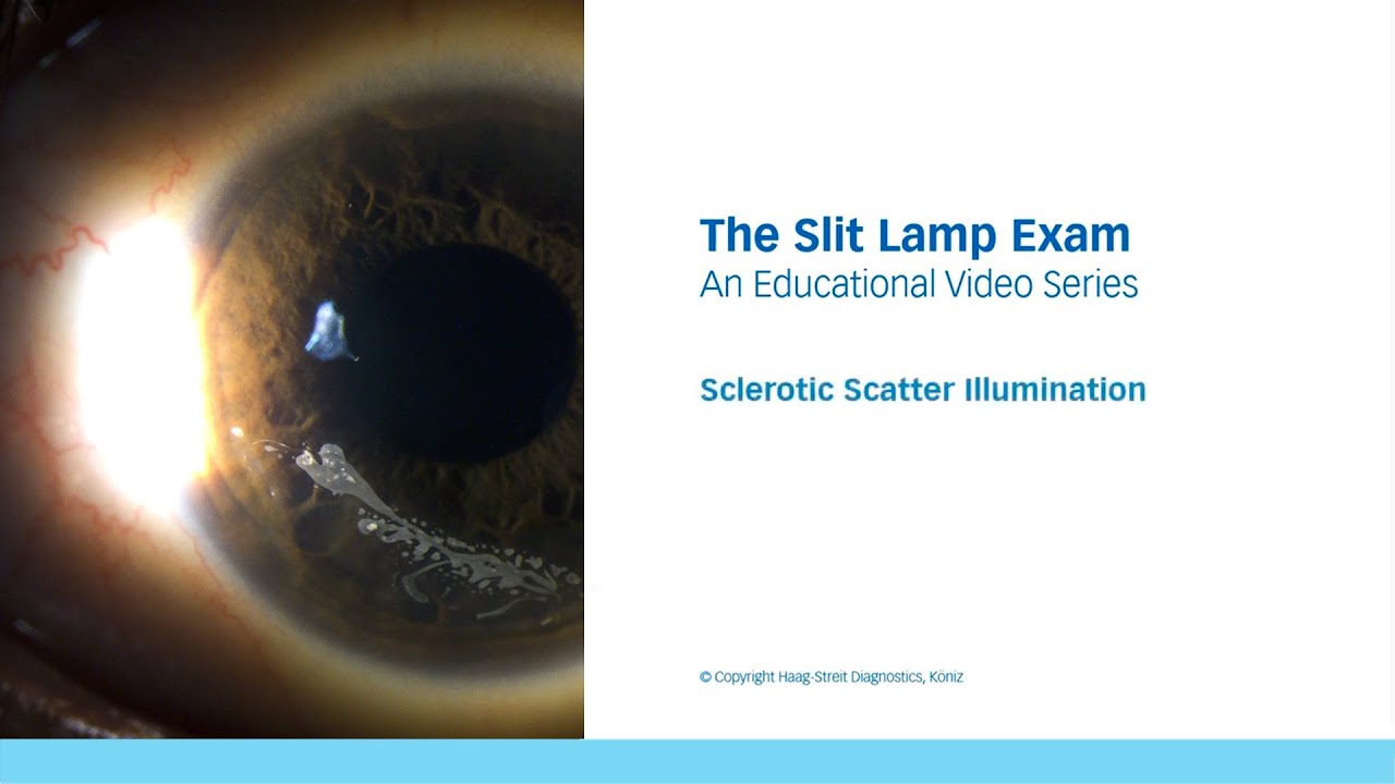 The Slit Lamp Exam – Episode 9, Sclerotic Scatter Illumination