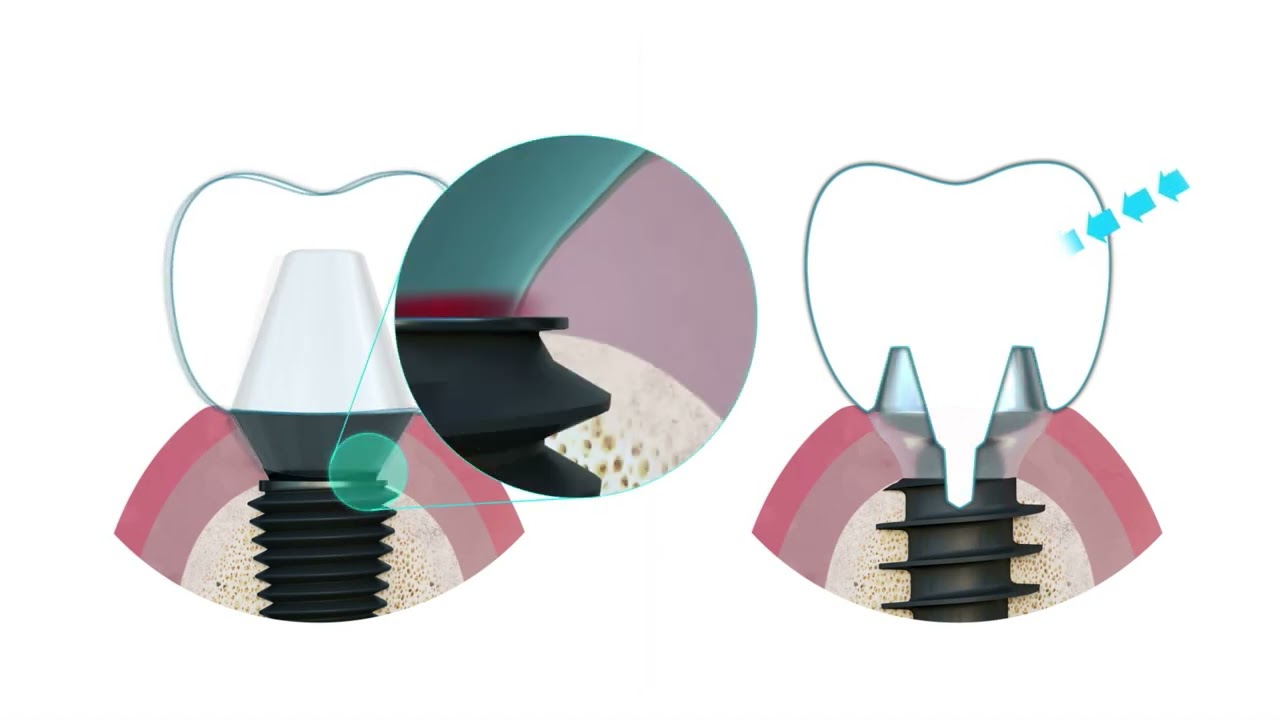 MagiCore & Fit Drilling System FR