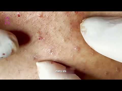 SATISFYING Forehead Blackheads And Whiteheads Extraction ASMR – Deep Pore Cleaning