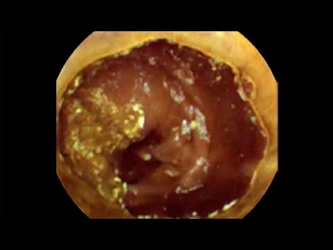 Pill Camera Swallowed | Follow Through Gut | Guts | Earth Lab