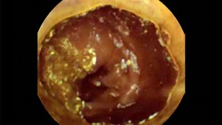 Pill Camera Swallowed | Follow Through Gut | Guts | Brit Lab | BBC