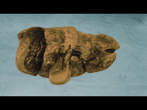 El extraño caso del joven muerto tras comerse unos espaguetis en mal estado