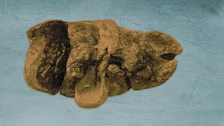 A Student Ate 5 Day Old Pasta For Lunch. This Is How His Liver Shut Down.