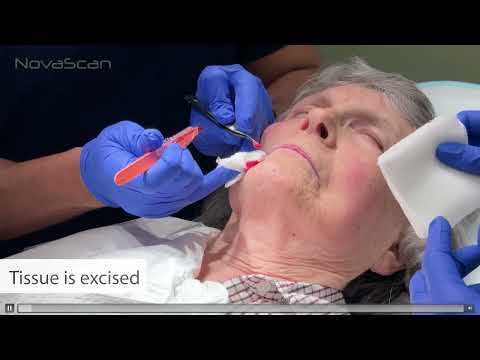 Craig Davis, NovaScan Inc - AI-assisted surgical margin cancer detection | LSI USA '26
