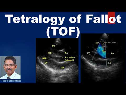 Tetralogy of Fallot TOF