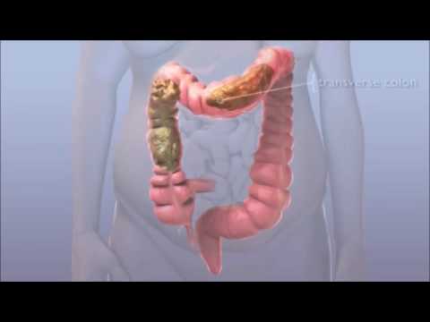 assorbimento acqua intestino crasso