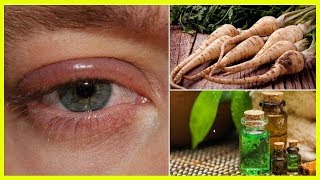 5 Home Remedies for Swollen Eyelids