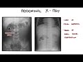 Intussusception