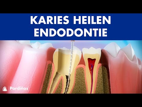 Karies heilen – Endodontie ©