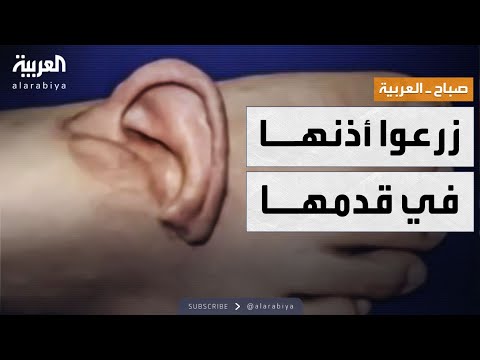 فيديو | صباح العربية | أطباء يزرعون أذن امرأة في قدمها في مشهد نادر