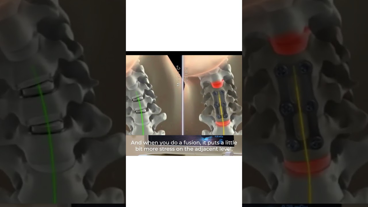 Mobi-C Artificial Disc Replacement: Cervical Spine Surgery