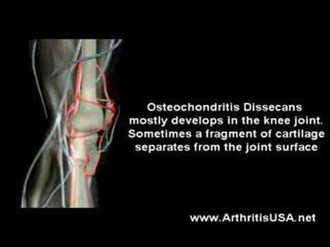 Knee pain due to Osteochondritis Dissecans by Dr Farshchian