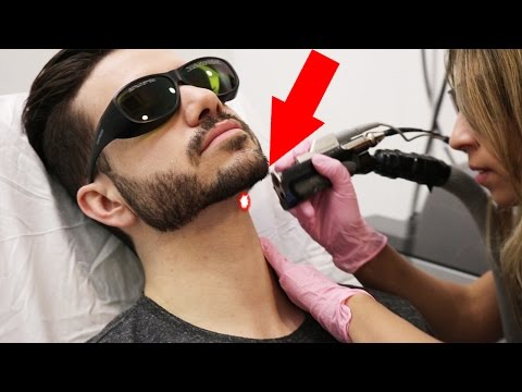 LASER HAIR REMOVAL FOR MEN | DOES IT HURT? ALEX COSTA