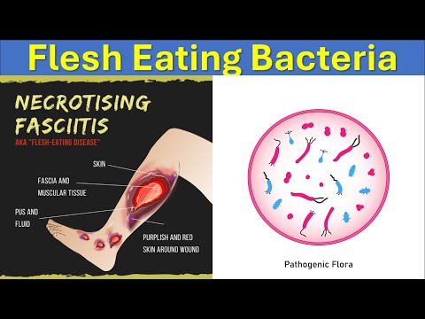 What Are Flesh Eating Bacteria? || Causes, Symptoms and Treatments Of Necrotizing Fasciitis