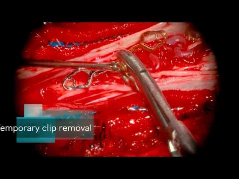 Microsurgical obliteration of a thoracic spinal perimedullary arteriovenous fistula