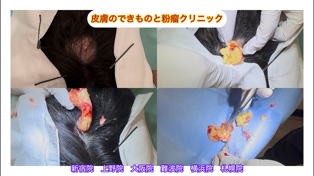 頭部の粉瘤　上野院　横浜院　札幌院も出来ました　ブログでも粉瘤について詳しく解説してます。東京皮膚のデキモノと粉瘤クリニック　ふるばやし形成外科　東京新宿院大阪難波院　大阪梅田形成外科クリニック