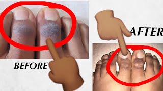 How To Get Rid Of Dark Rough And  Flaky Feet Before  And After Photos