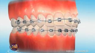 After Getting Braces On: The First Few Days: Nirenblatt Orthodontics