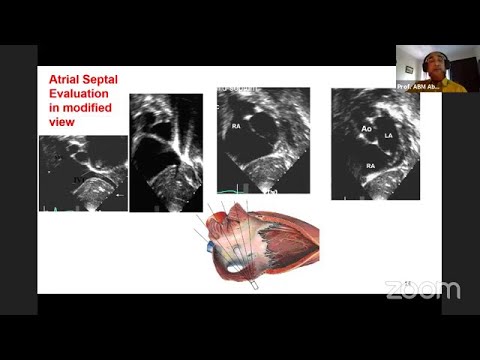 Echo 9 (Congenital Heart Disease & Cyanotic CHD)