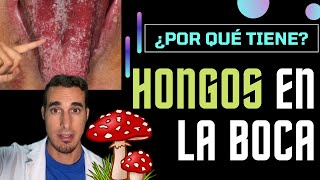 HONGOS en la BOCA y LENGUA - Causa, síntomas y tratamiento de la CANDIDIASIS #shorts