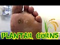 MINIMALLY INVASIVE SURGERY TO ELIMINATE PAINFUL PLANTAR CORNS DEBRIDEMENT OF THE CORNS INCLUDED ️