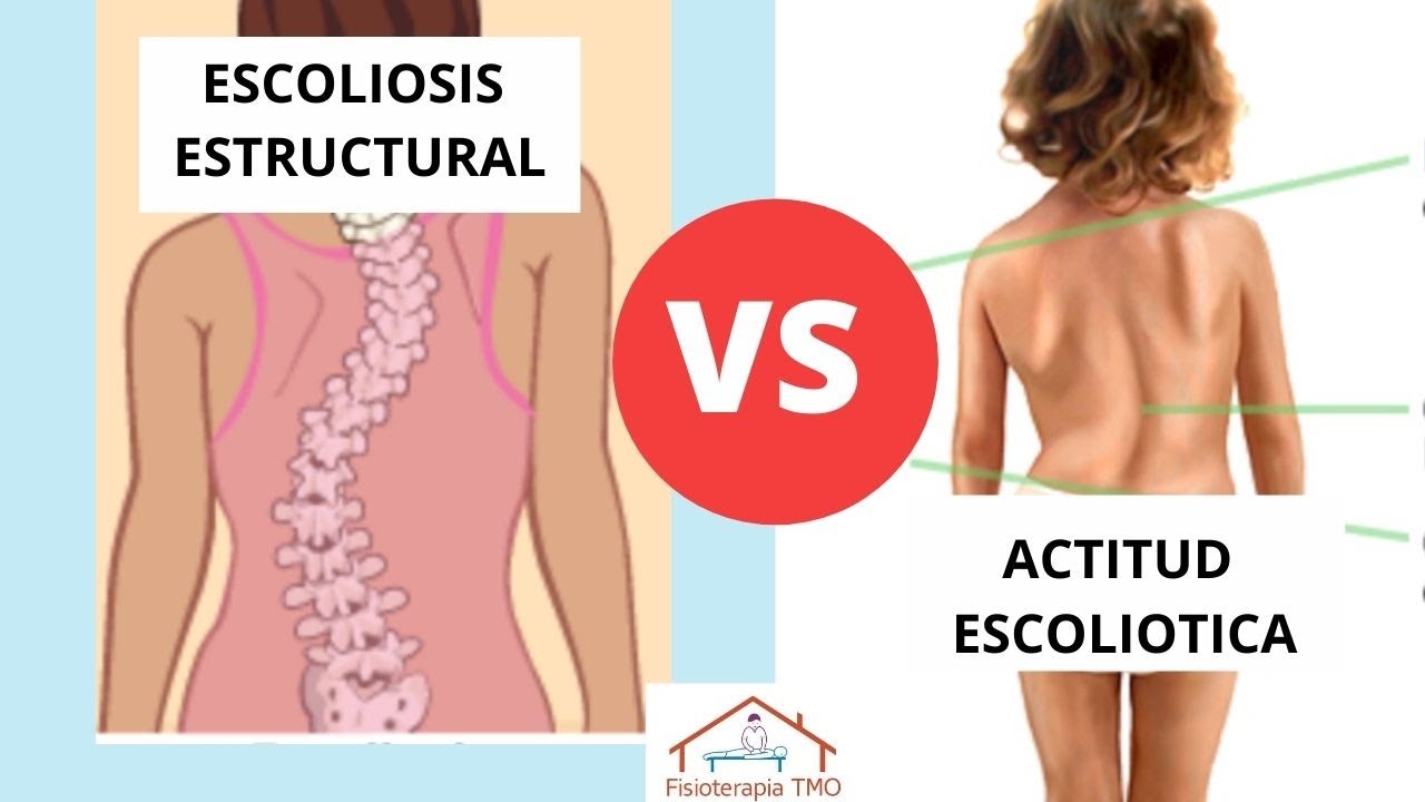 Watch Escoliosis causa y Diferencia entre actitud escoliotica y escoliosis estructural Now Escoliosis causa y Diferencia entre actitud escoliotica y escoliosis estructural