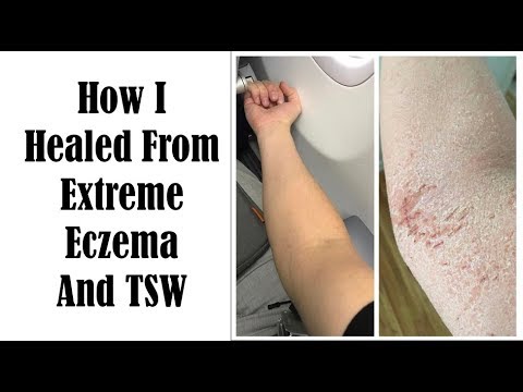 Top 10 Things To Heal From Eczema and TSW - My Journey of Healing