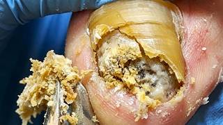 Why You Must Trim Thick Onychomycosis Very Carefully【Xue Yidao】