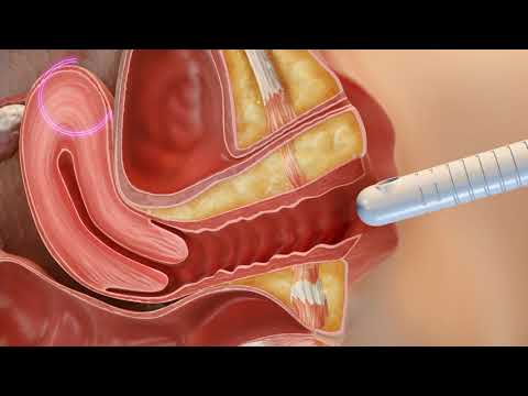 CORE Intima MOA Video