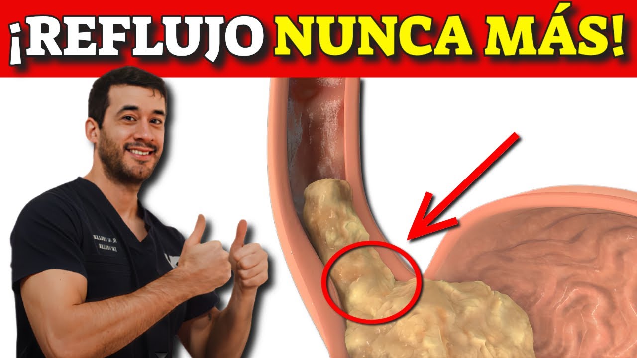 How to CURE ACID REFLUX?| Tips to Improve Heartburn