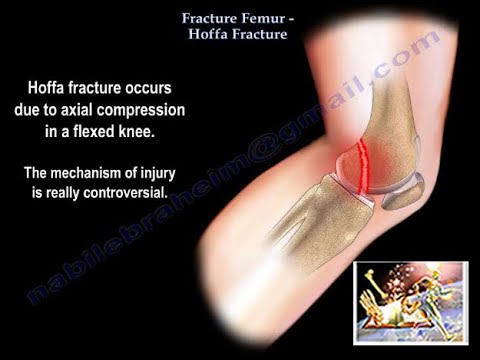 Fracture Femur Hoffa Fracture - Everything You Need To Know - Dr. Nabil Ebraheim