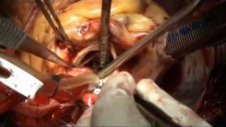 Emergecy CABG & retreival of impacted stent in Left main coronary artery