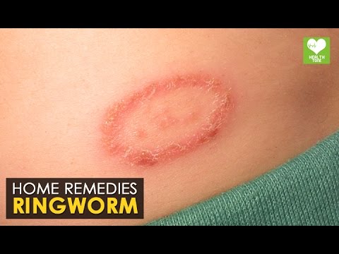 Magandang cream para sa paa mula sa halamang-singaw Antiseptic laban halamang-singaw sa kanyang mga paa