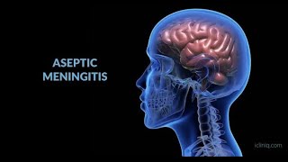 Aseptic Meningitis; inflammation of the meninges, not caused by bacterial infection