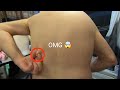 Insane Back Pimple Bursting Extravaganza