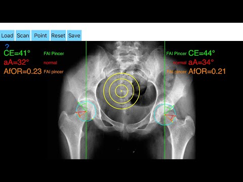 FMI Hip Measurement video thumbnail
