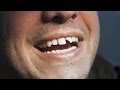 How to Deal with Broken Teeth | Tooth Care