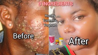 Remove Pimples  Acne /Dark spots Over night with Honey Turmeric and Yoghurt #beauty #couple