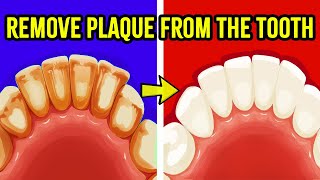 How To Get Rid of Plaque Build Up On Your Teeth At Home | 5 Ways to Remove Plaque From the Tooth