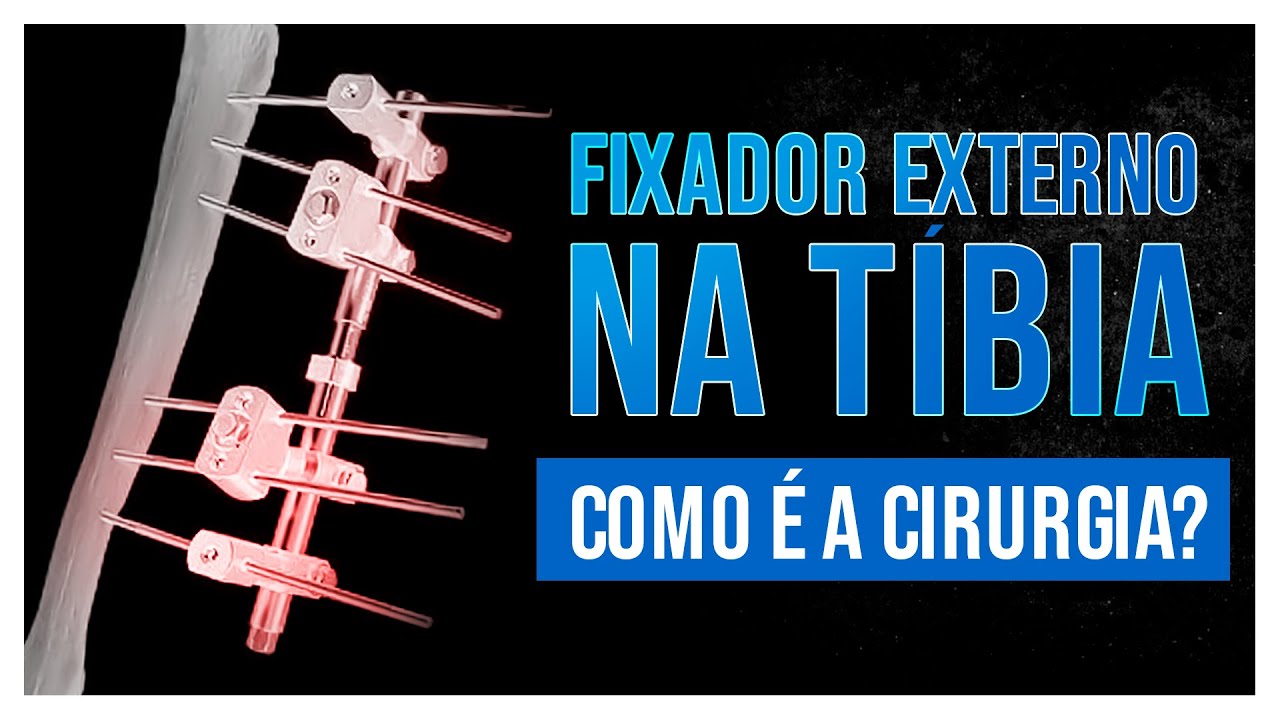 CIRURGIA ORTOPÉDICA | COMO É A CIRURGIA DE FIXADOR EXTERNO NA TÍBIA