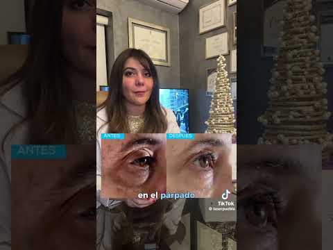 JuveLook en Puebla: bioestimulador híbrido PLLA + HA | Dra. Dafne Arellano