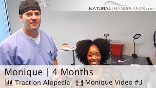 Traction Alopecia | 4 Months Post HUE Method Female Hair Transplant (Monique)