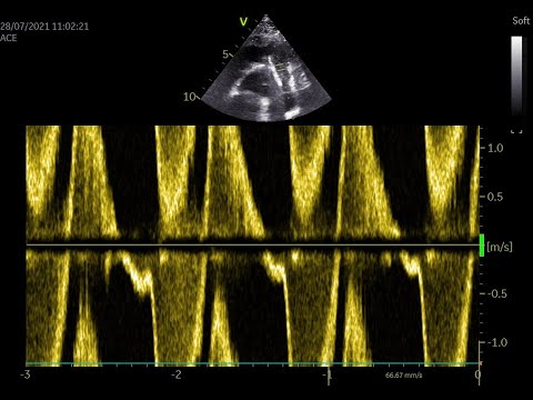 Stiff Right Ventricle Tétralogie de Fallot thumbnail