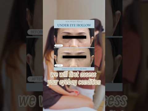Non-Surgical Eye Bag Removal | Causes & Solutions 
