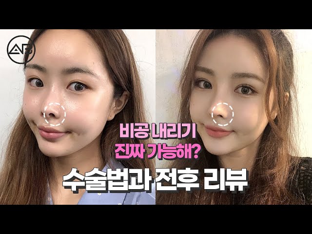 코재수술비용 합리적인 9