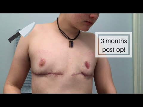 3 months post-op double incision top surgery