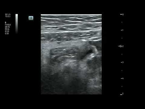 RLQ Mesenteric Adenitis from Tuberculosis
